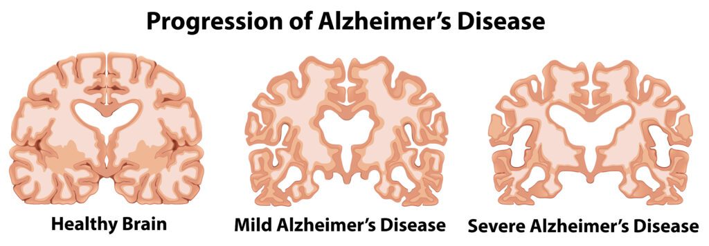 Progression of Alzheimer's disease