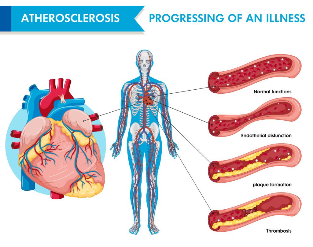 CAD is a major macrovascular complications of diabetes