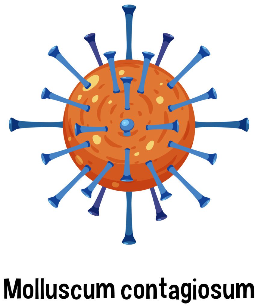 Zelsuvmi is a novel drug for molluscum contagiosum infections